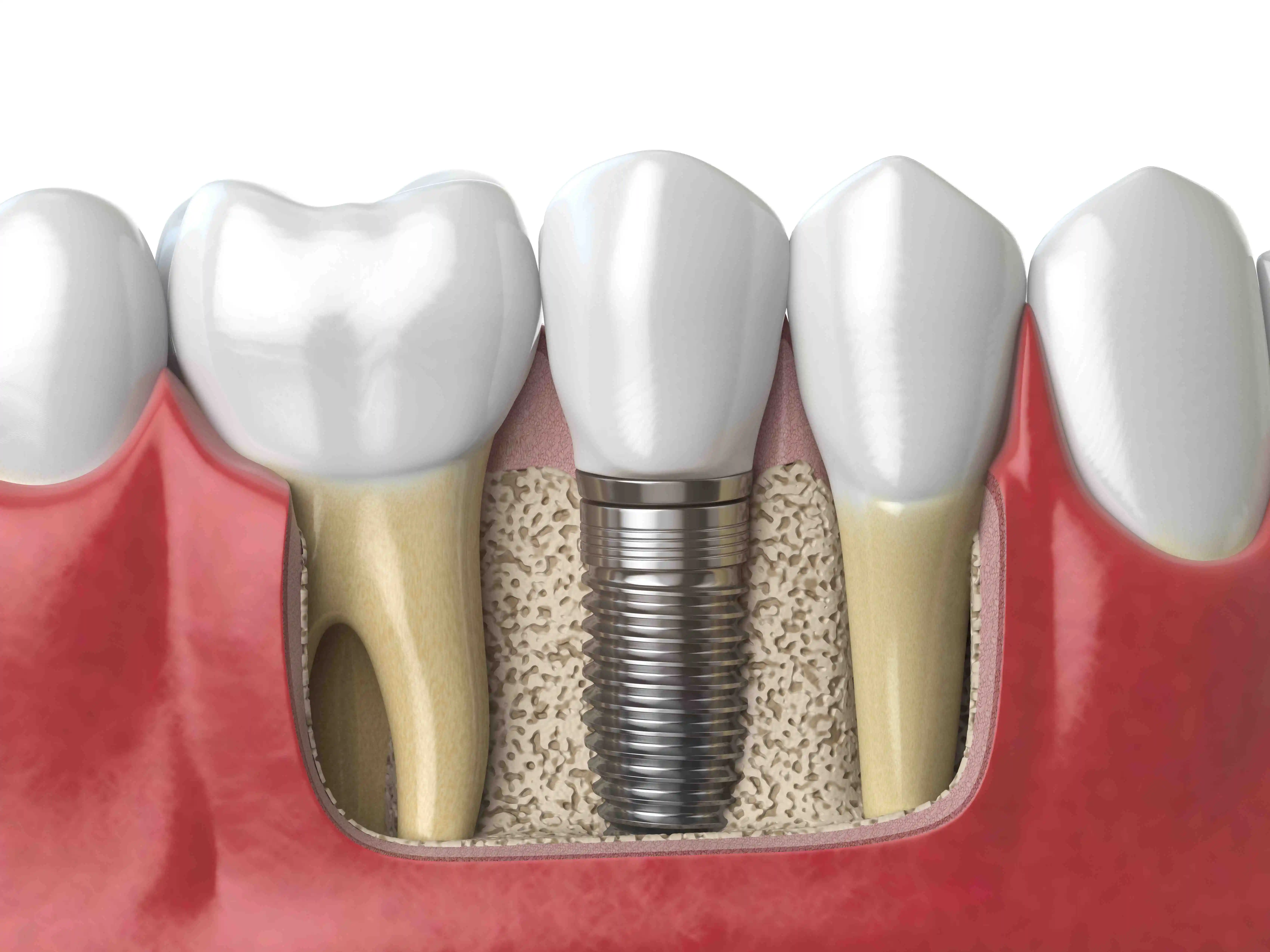 Dental Bone Graft