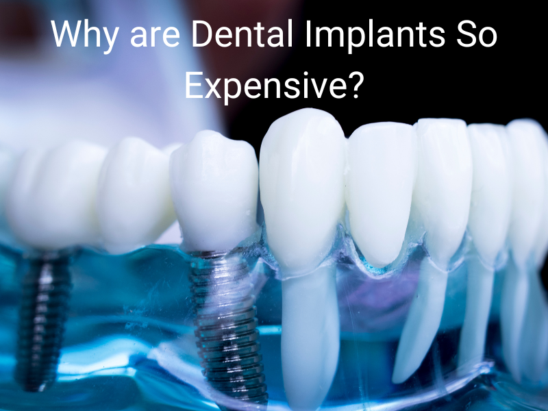 You are currently viewing Why are Dental Implants So Expensive?
